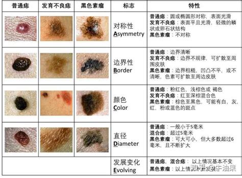 陰部 痣|痣是什麼？會變成黑色素瘤？7種一定要除的痣